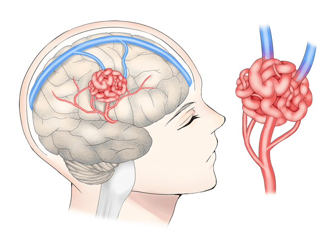 脳動静脈奇形(AVM)イメージ